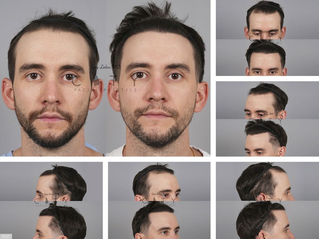 Hair Transplant F237