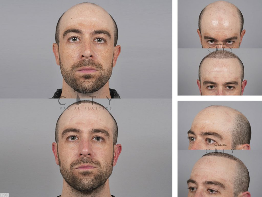 Hair Transplant F238