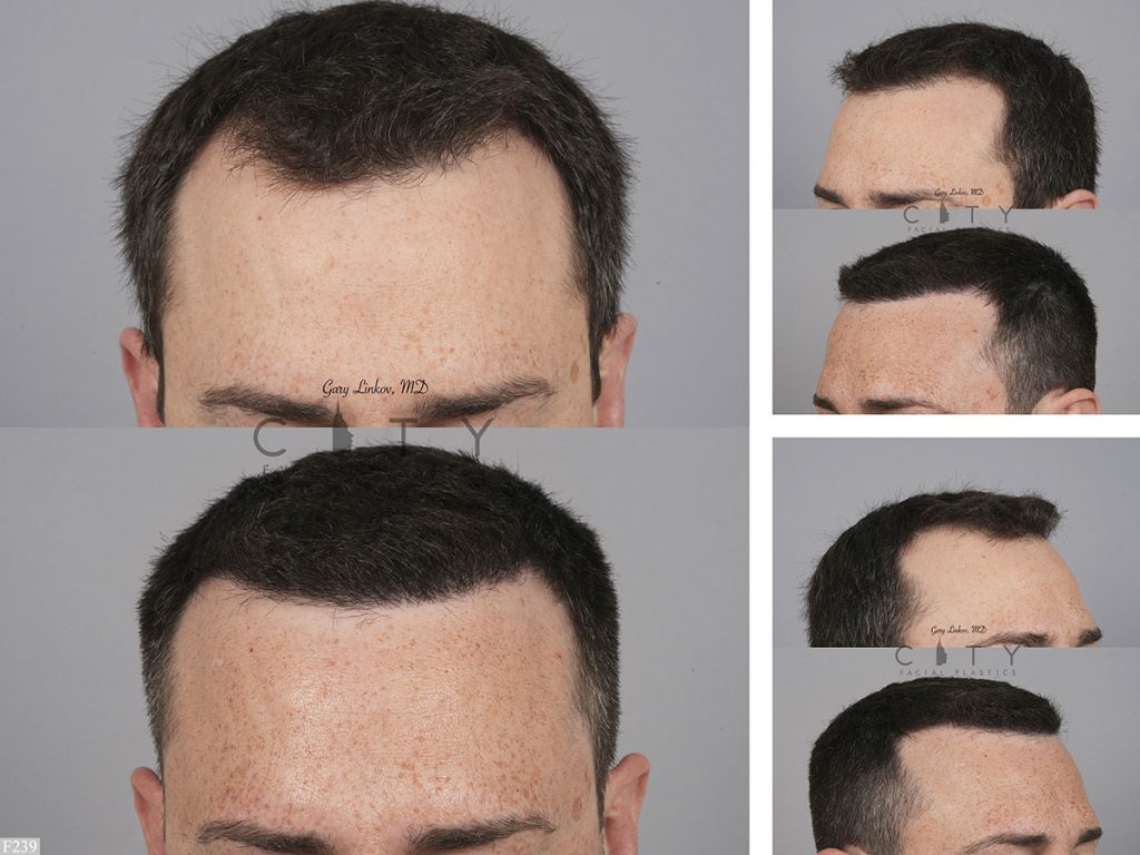 Hair Transplant F239
