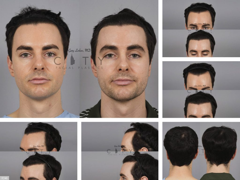 Hair Transplant F240