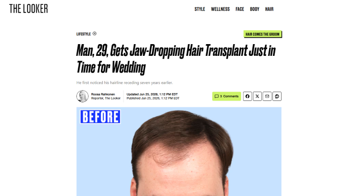 Man, 29, Gets Jaw-Dropping Hair Transplant Just in Time for Wedding