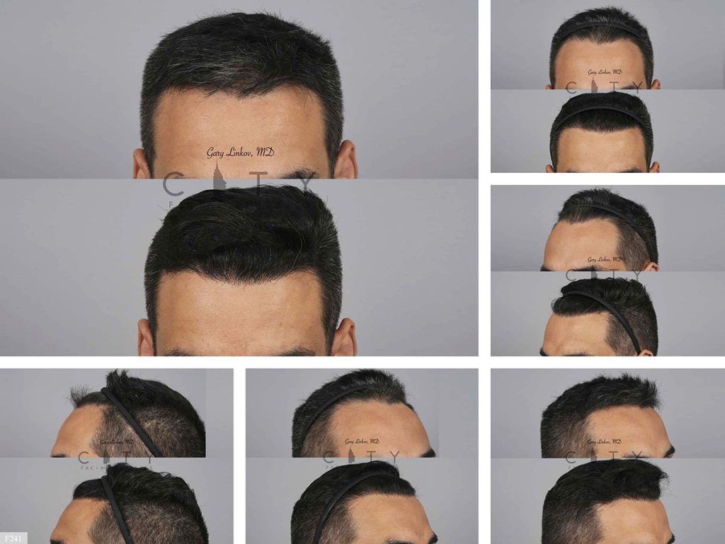Hair Transplant F241