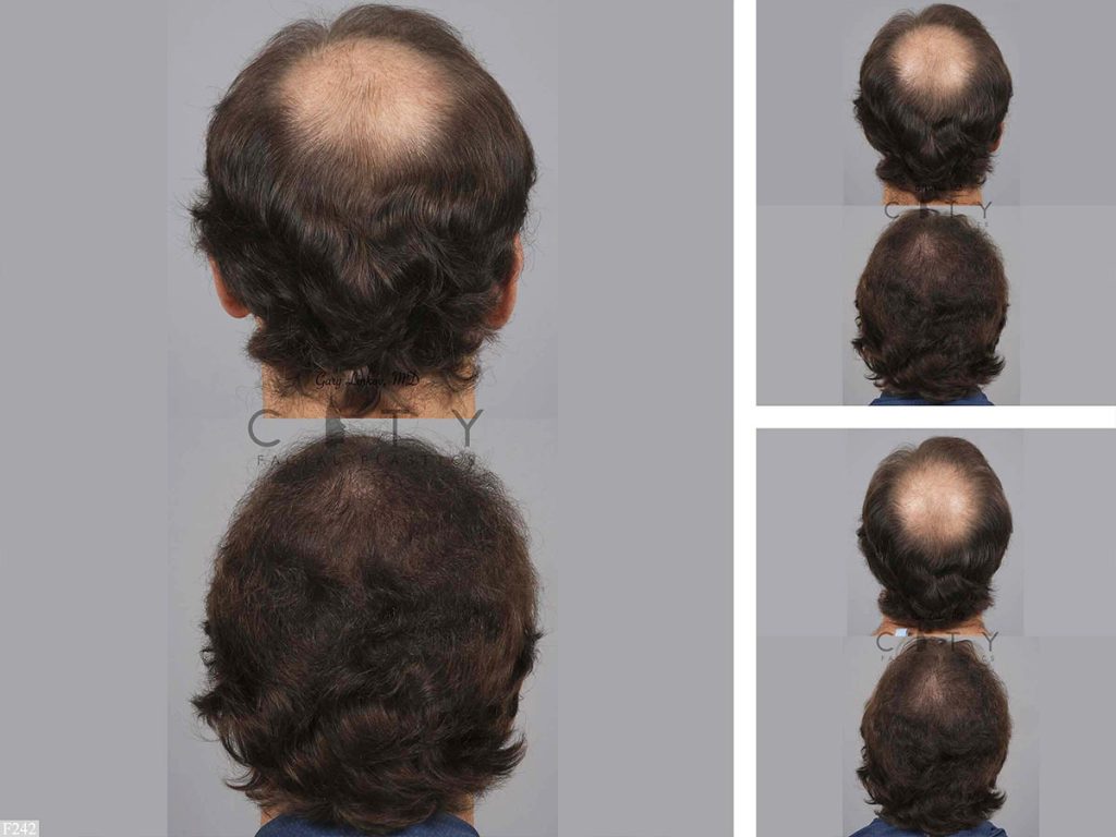 Hair Transplant F242