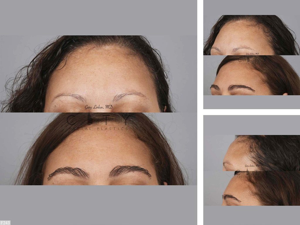 Hair Transplant F243