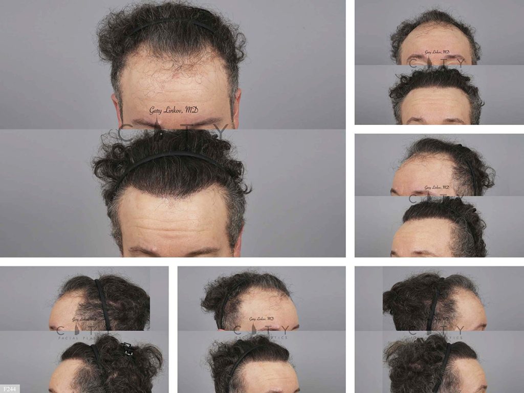 Hair Transplant F244