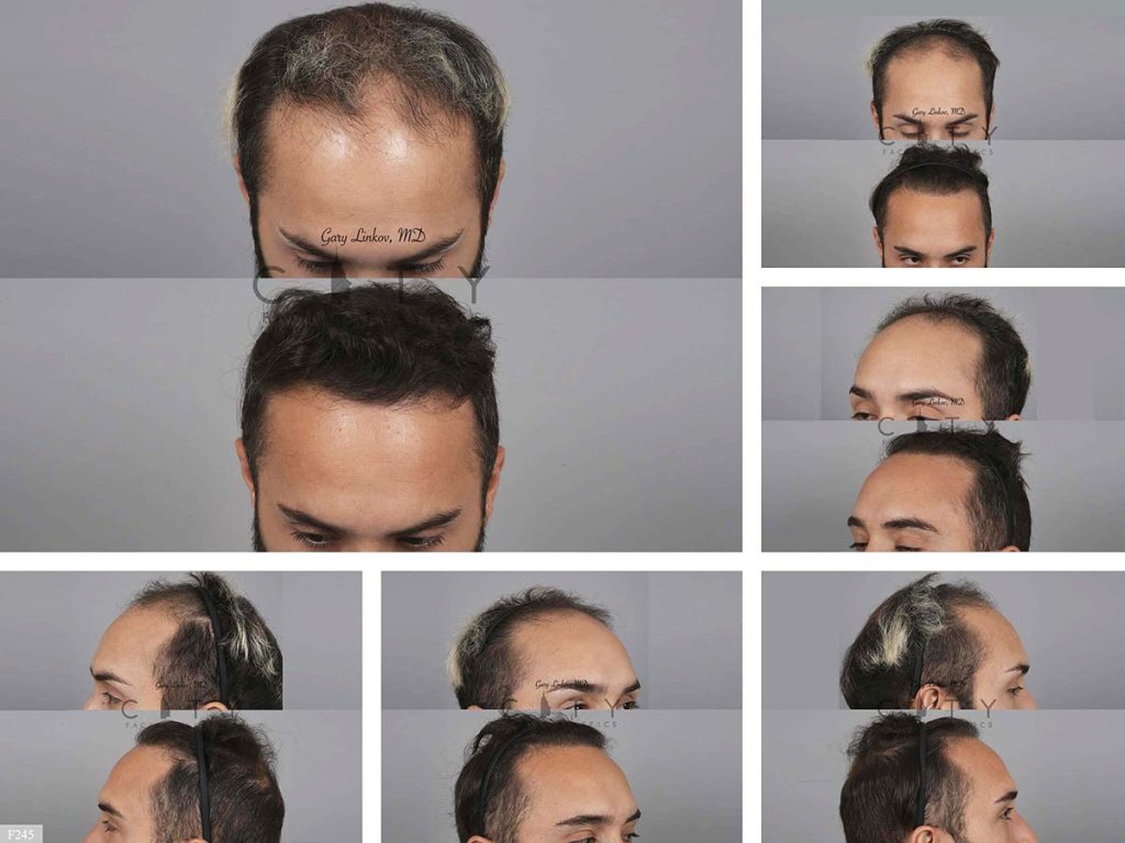Hair Transplant F245