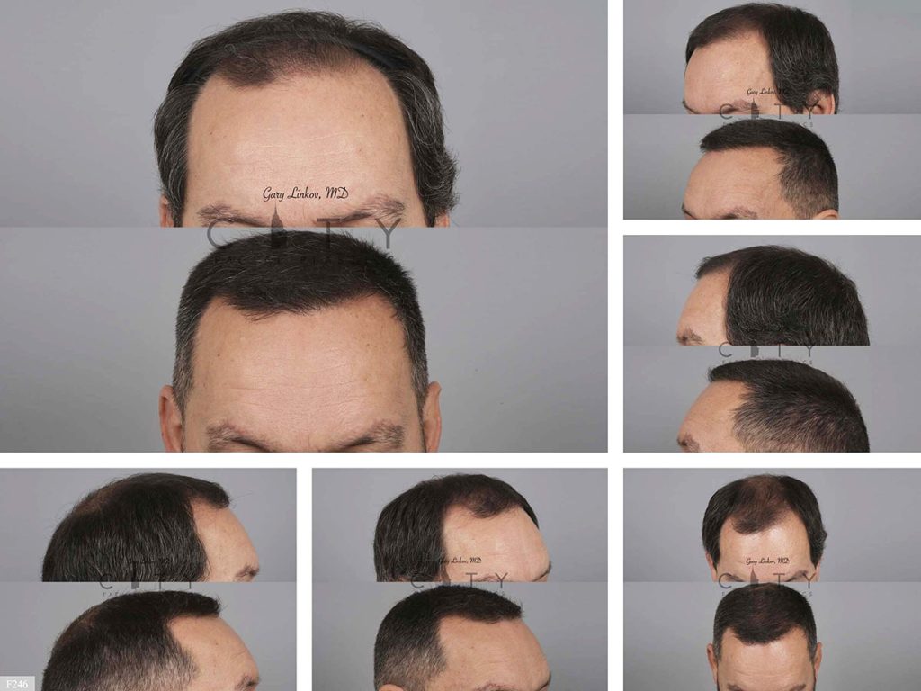 Hair Transplant F246