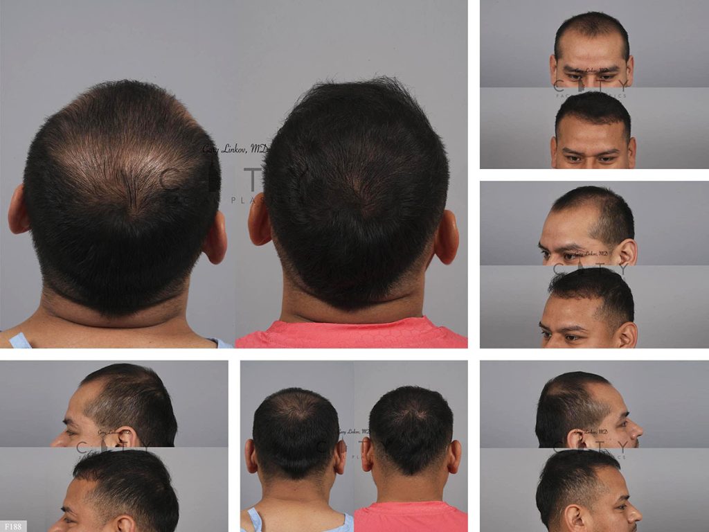 Hair Transplant F188