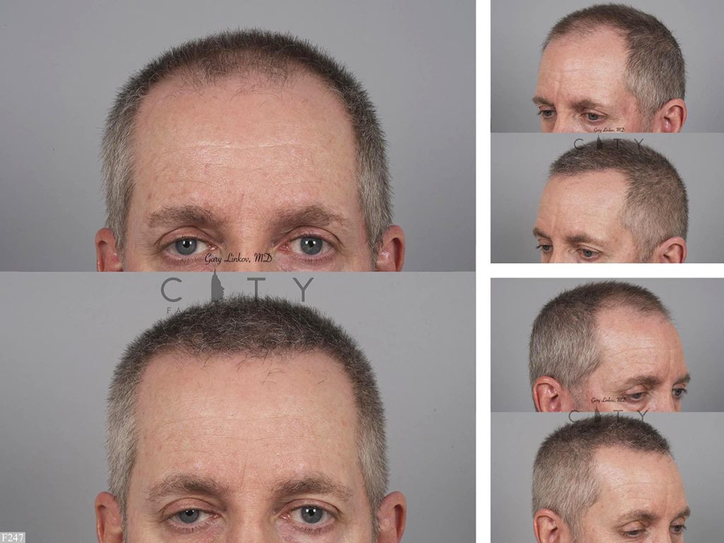 Hair Transplant F247