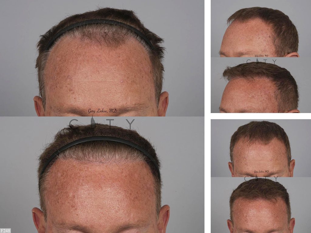 Hair Transplant F248