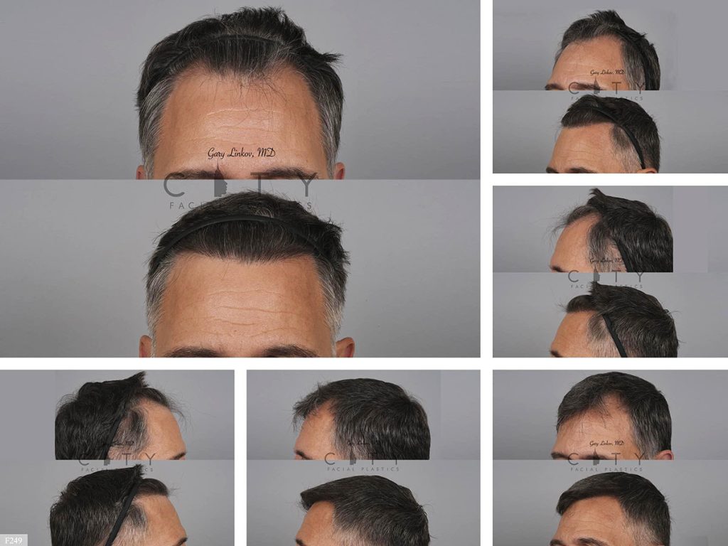 Hair Transplant F249