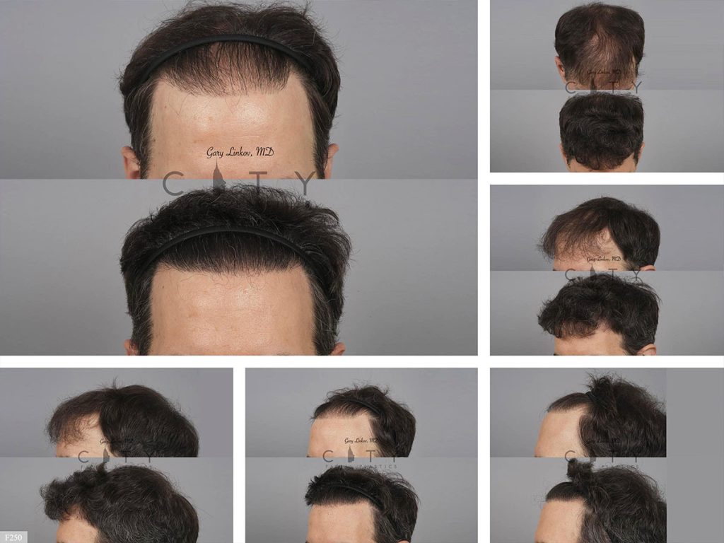 Hair Transplant F250