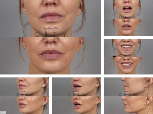 Lip Lift G122