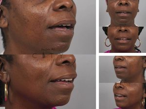 Lip Lift G123