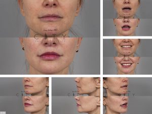 Lip Lift G124
