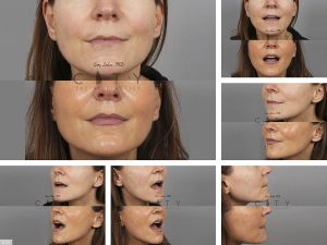 Lip Lift G125