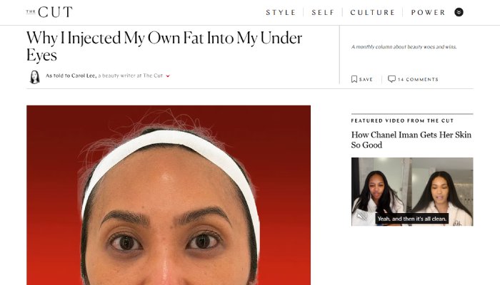 Why I Injected My Own Fat Into My Under Eyes